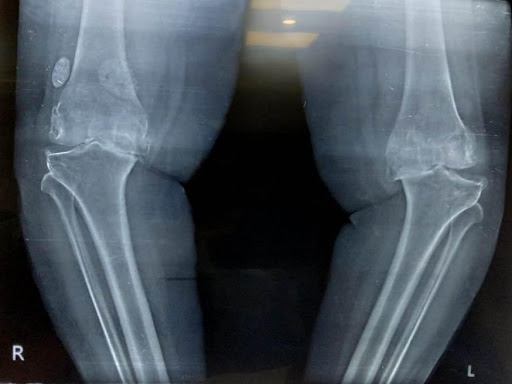 Pre and post-op x-ray of a patient-1